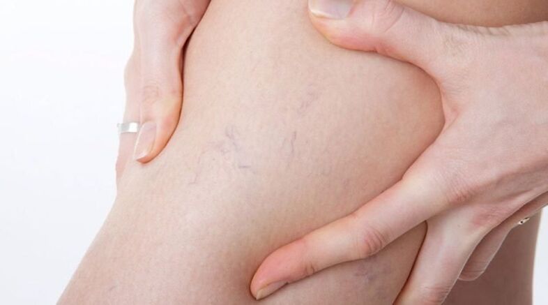 Segni di vene varicose nelle gambe di una donna - vene varicose