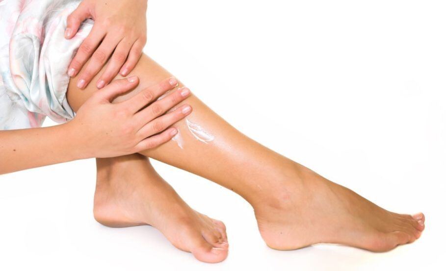 Applicazione di crema medicata sulle gambe per alleviare i sintomi delle vene varicose