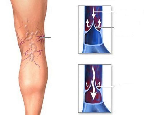 conseguenze delle vene varicose delle gambe